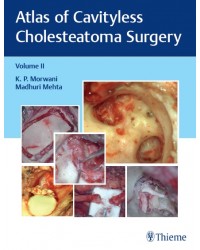 Atlas of Cavityless Cholesteatoma Surgery
