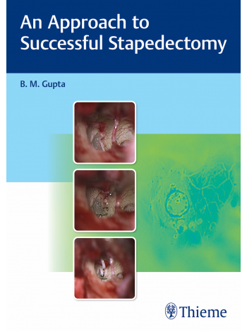 An Approach to Successful Stapedectomy